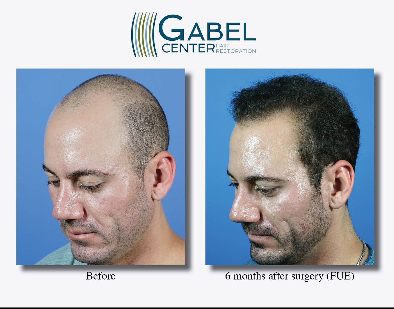 人気ランキング Frontal Grafts- 2168 FUE Hairline 6 – MD Gabel, Steven - SF・ファンタジー・ホラー